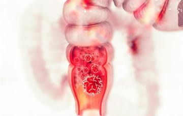 ¿Cual es el tipo de cáncer de colon más frecuente ?