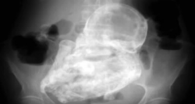En décembre 2013, des chirurgiens colombiens ont découvert un foetus pétrifié dans l'organisme d'une patiente. Il s'y trouvait depuis…