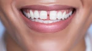 Comment appelle t'ont ces dents ?