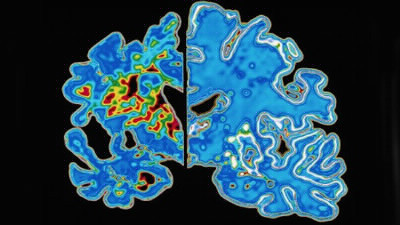 Combien de français seraient atteints de la maladie d’Alzheimer en 2013 ?