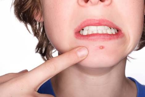 Tipo de acne conhecida como ESPINHA: