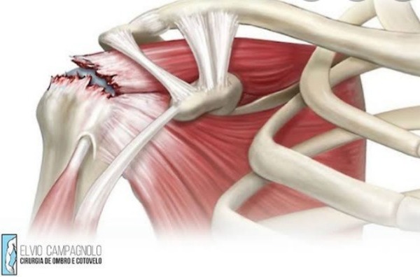 Ruptura nos tecidos que ligam o músculo ao osso (tendões) em torno da articulação do ombro. A que nome se dá essa lesão ?