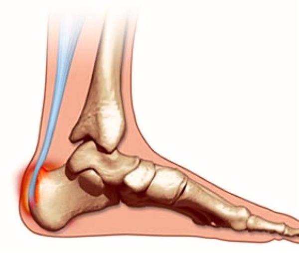 Malformation de l'os du talon entraînant une inflammation du talon d'Achille (j'aurais pu mettre une photo de mes pieds comme image), la maladie de ...