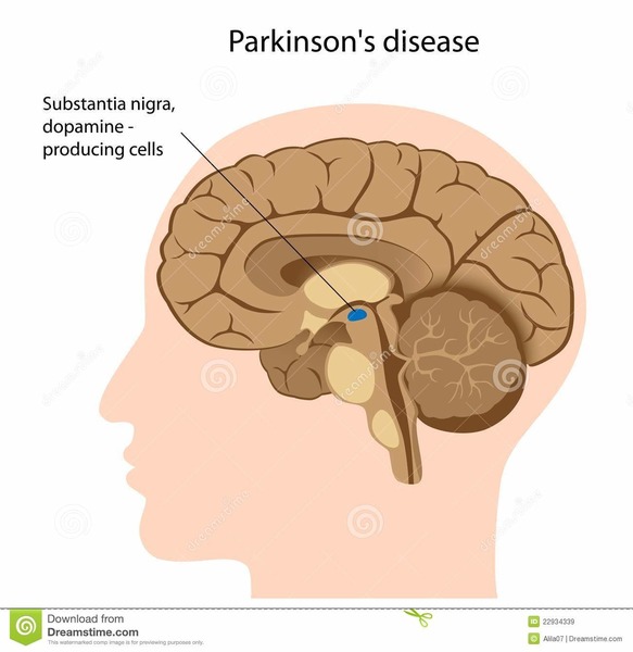 La maladie de Parkinson est une maladie...