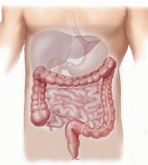 ¿A quienes afecta principalmente el Cancer de colon?