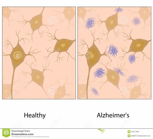 La maladie d'Alzheimer est une maladie neurodégénérative incurable à ce jour du ......