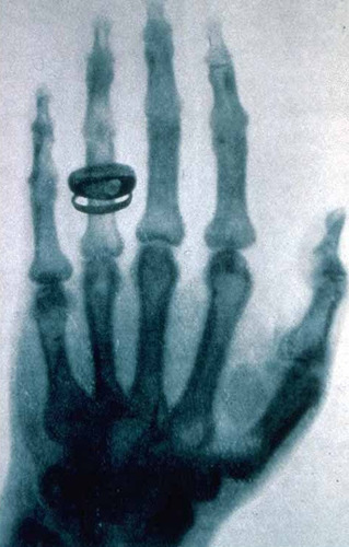 Quelle découverte faite par l'allemand Rontgen en 1895 va donner naissance à l'imagerie médicale (radiologie) ?