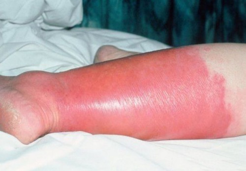 Ostry stan zapalny skóry i tkanek leżących głębiej, umiejscawia się najczęściej na twarzy i kończynach dolnych