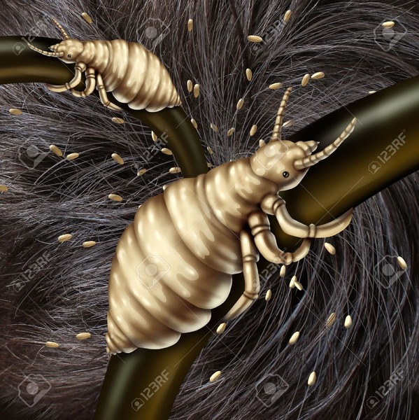 Quel insecte parasite de l'homme peut-on retrouver dans nos cheveux ?